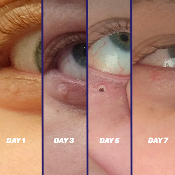 Skin Tag Remover Pen – Quick & Painless
