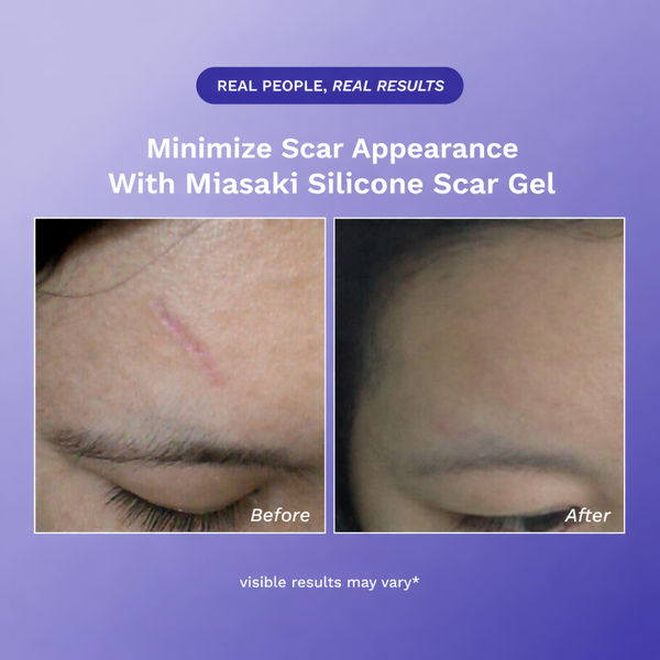 Velora Silicone Scar Gel