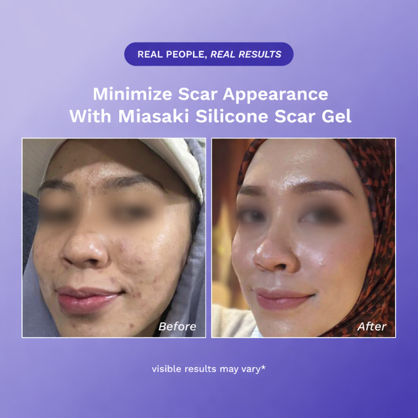 Velora Silicone Scar Gel