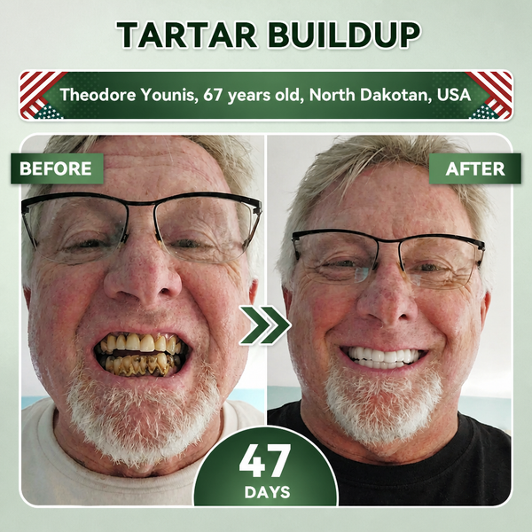 SmileRenew Fast Dental Repair Strips