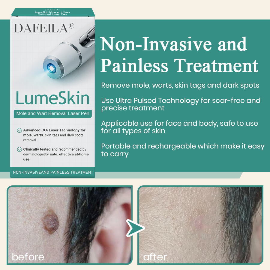 LumeSkin Mole and Wart Instant Removal Laser Pen