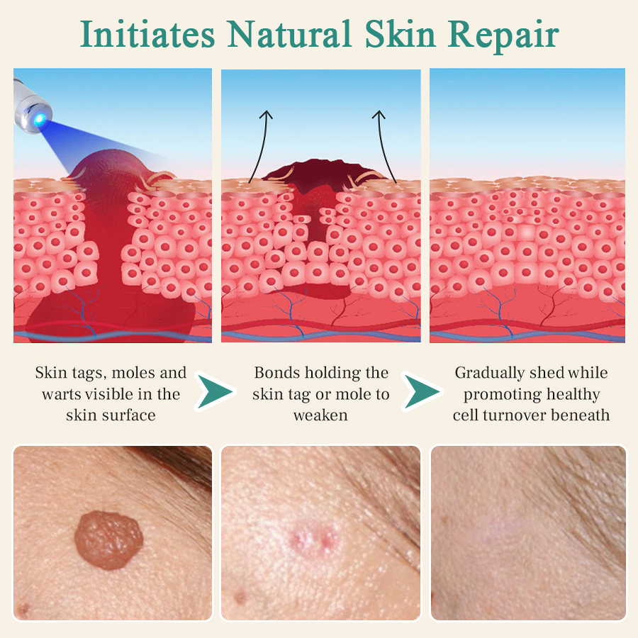 LumeSkin Mole and Wart Instant Removal Laser Pen