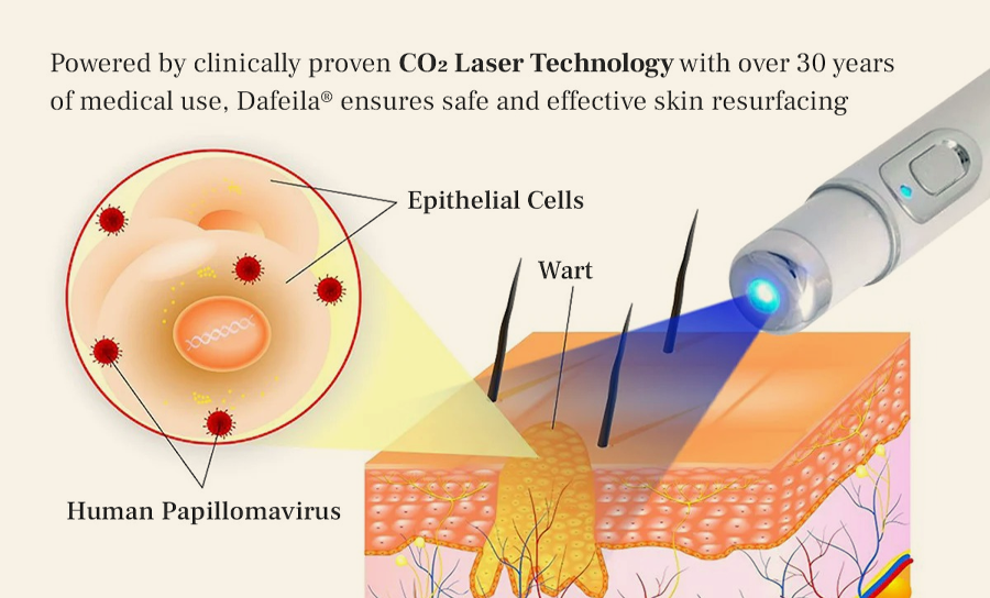 LumeSkin Mole and Wart Instant Removal Laser Pen