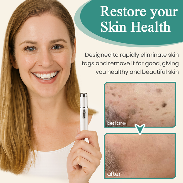 LumeSkin Mole and Wart Instant Removal Laser Pen