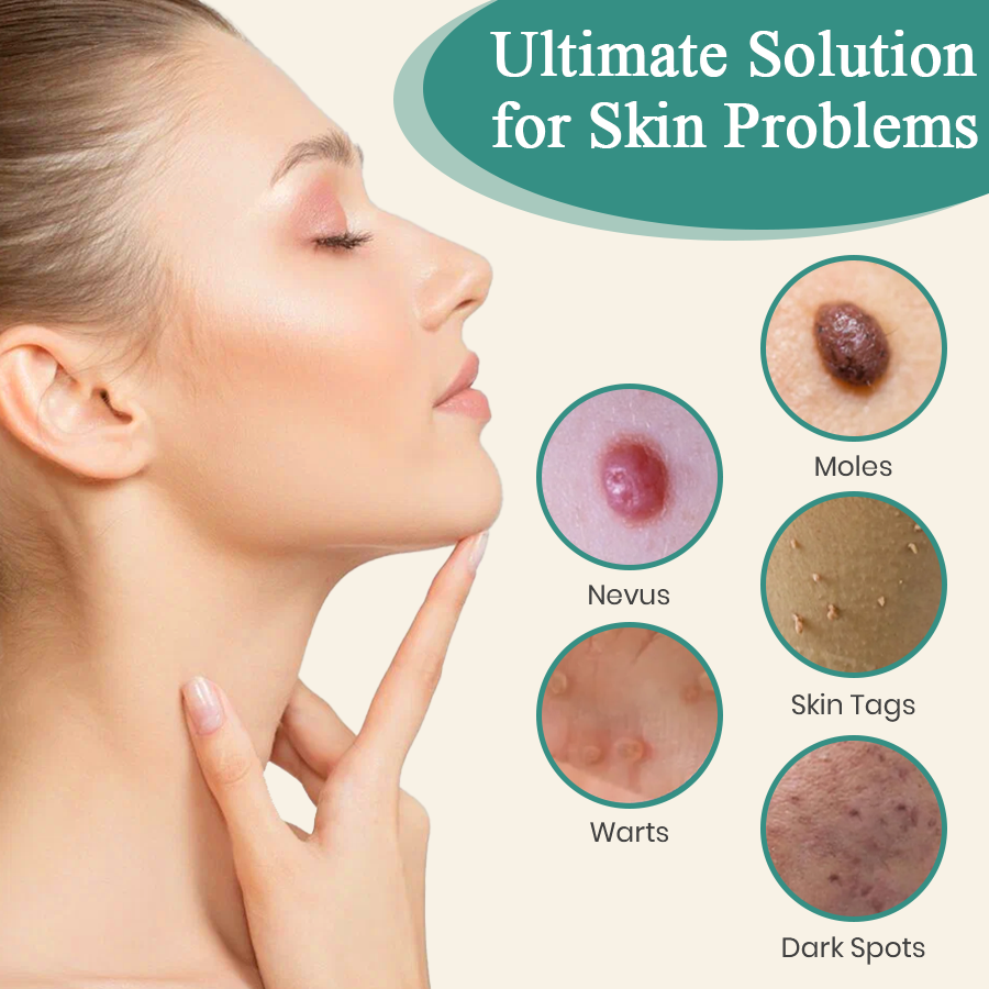 LumeSkin Mole and Wart Instant Removal Laser Pen
