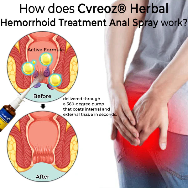 Herbal Hemorrhoid Treatment Anal Spray